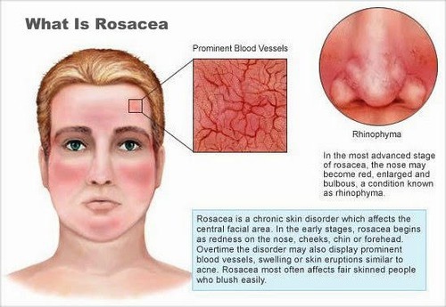 what-is-rosacea