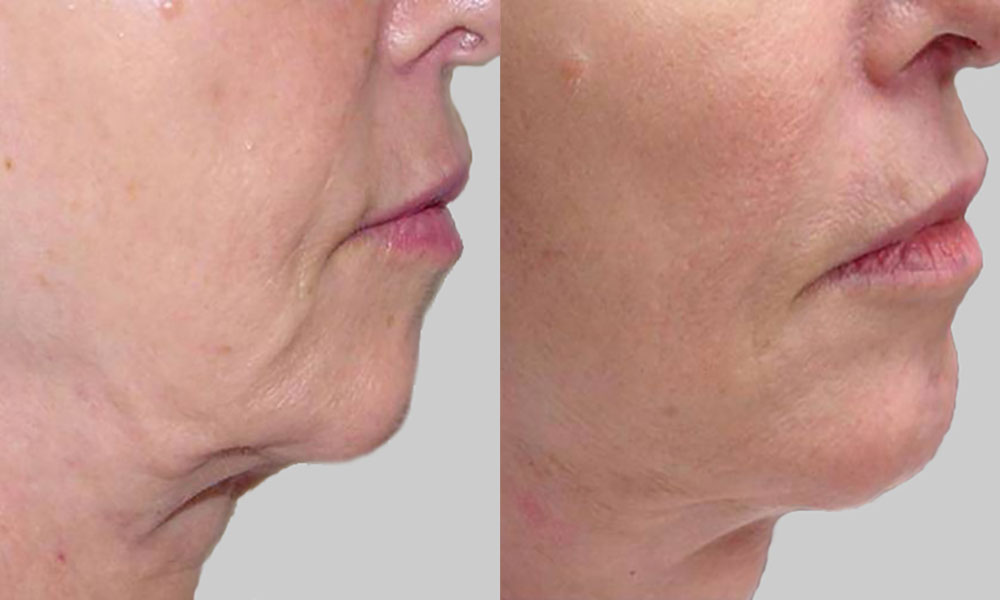 Exilis Body Shaping and Skin Tightening! - The Laser Image Company