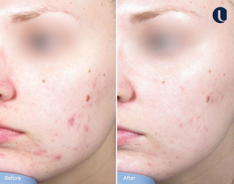 IPL Acne Treatment | Skin Treatment | River Aesthetics