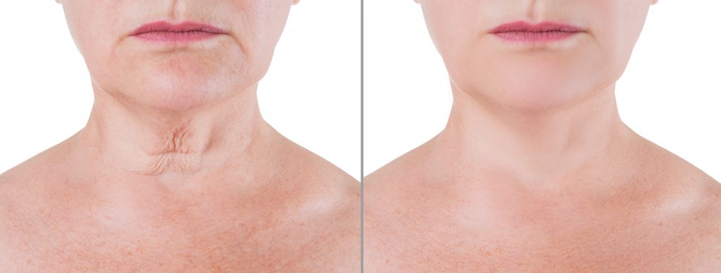 Neck Rejuvenation, Treatment Options