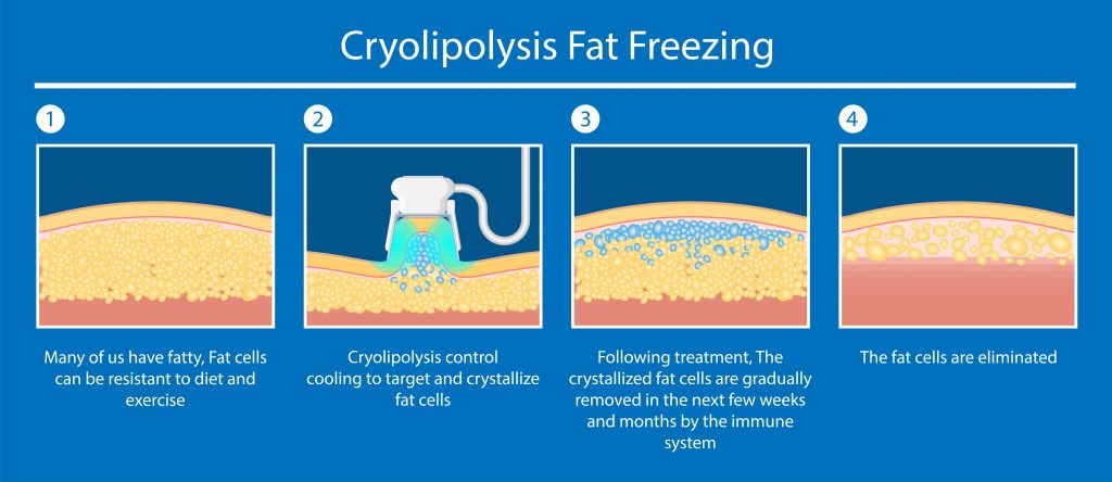 fat freezing explained