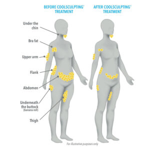 Axillary Puffs CoolSculpting Before & After Patient 02